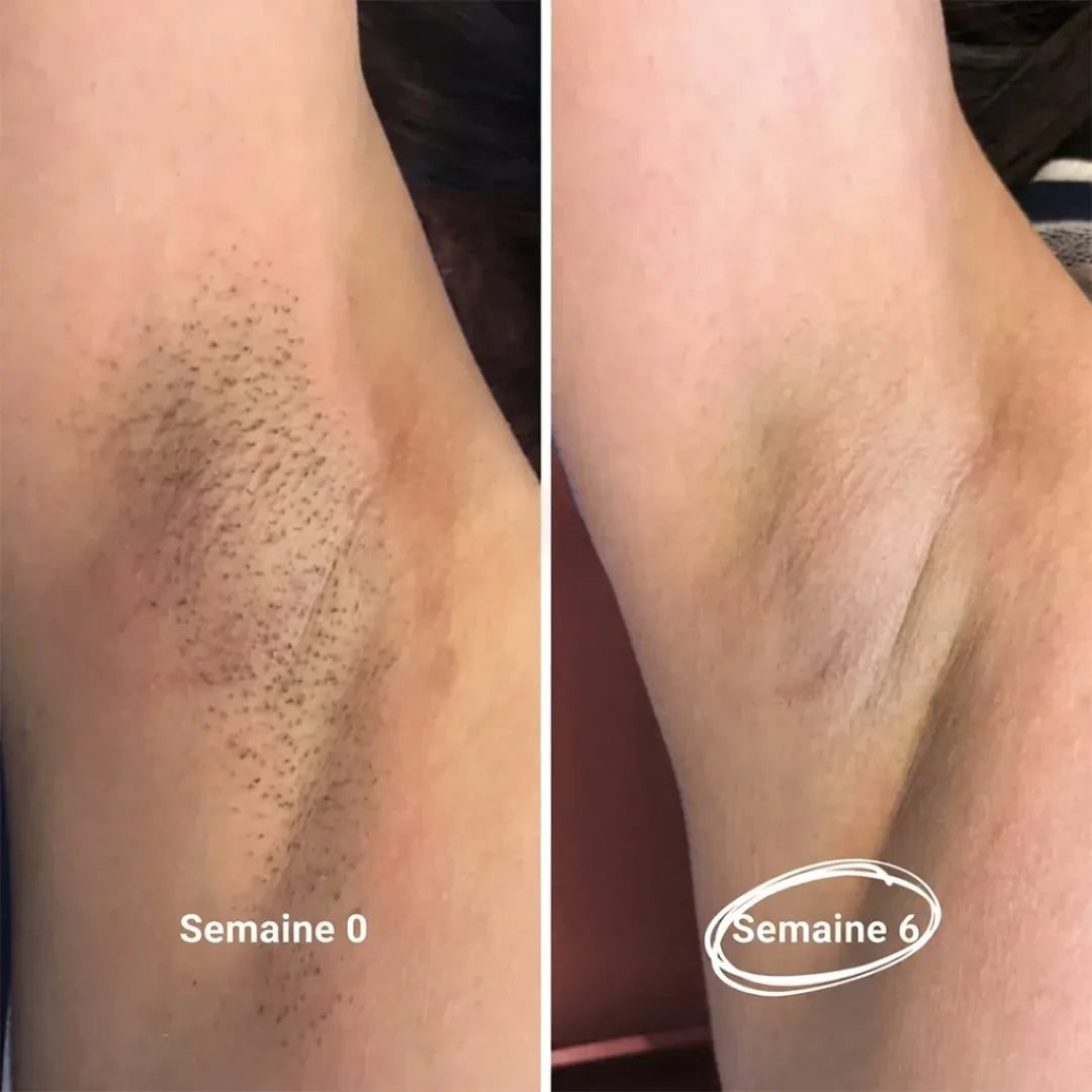 Épilateur IPL Permanent