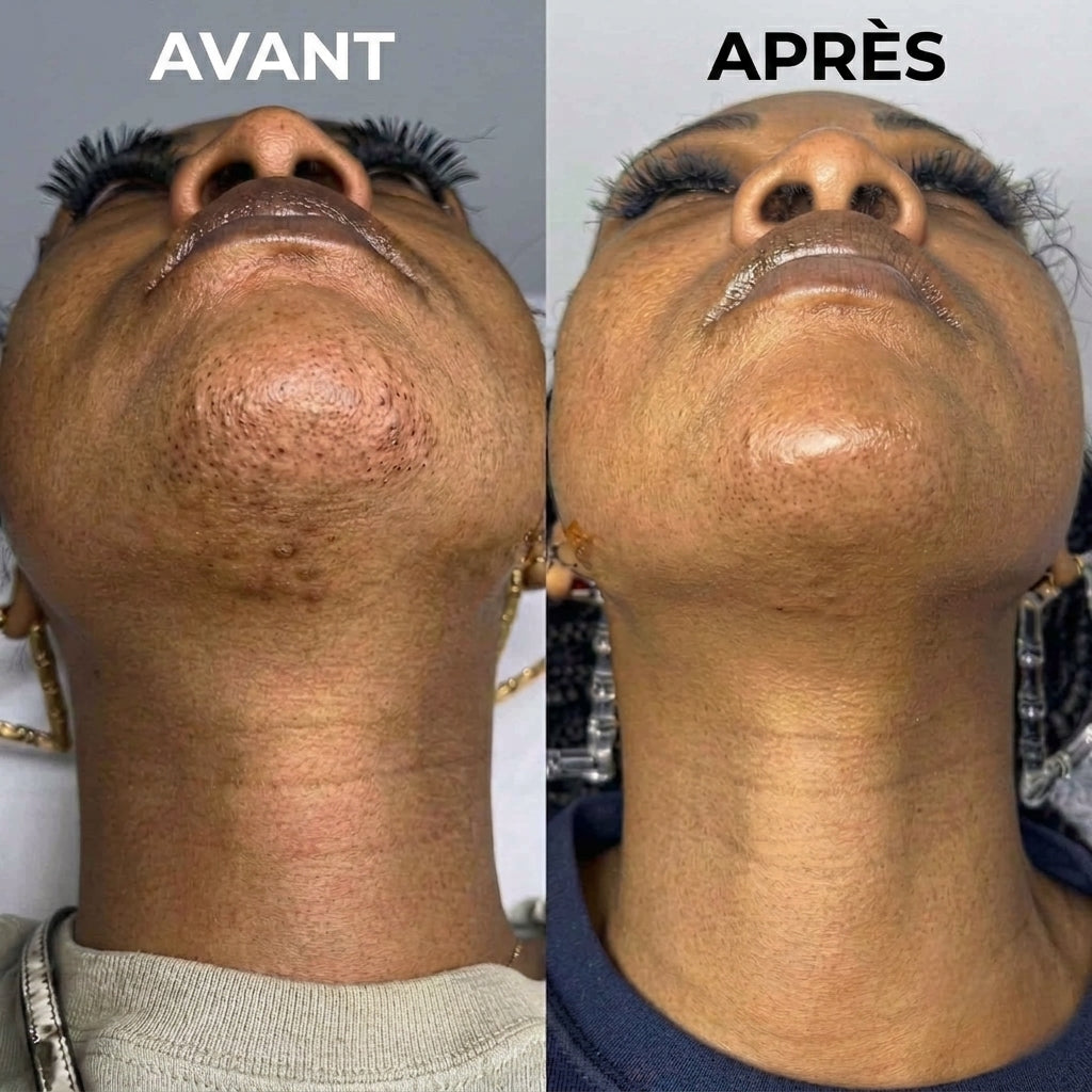 Stop à la pousse des poils, formule végétale