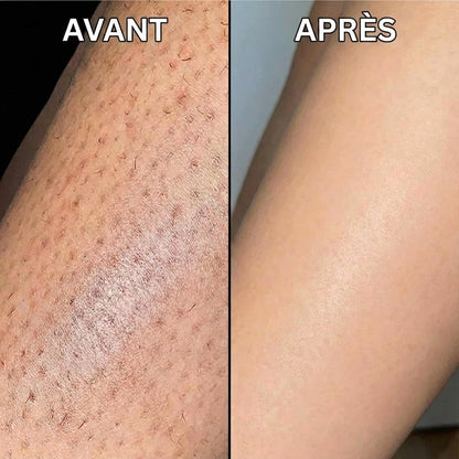 Stop à la pousse des poils, formule végétale