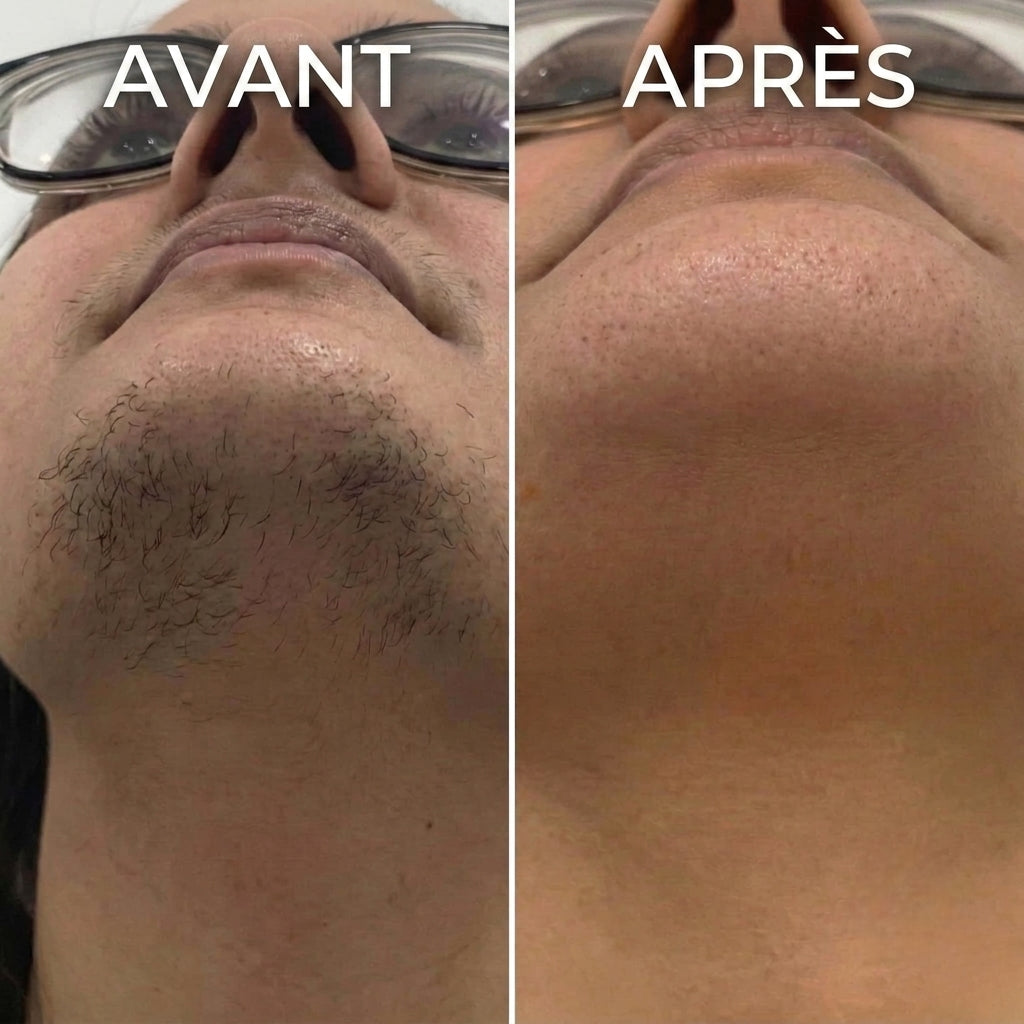 Stop à la pousse des poils, formule végétale