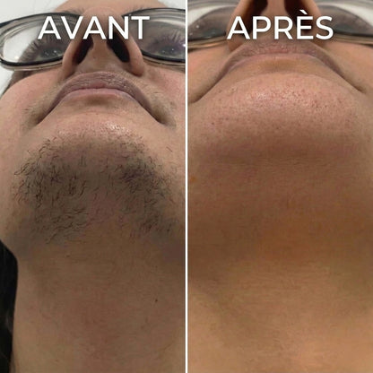 Stop à la pousse des poils, formule végétale